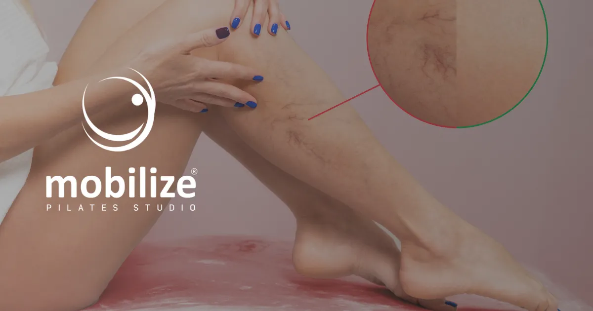Pilates como aliado no combate aos sintomas das varizes